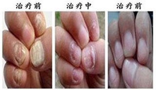 患者资料:陈女士,34岁患者主诉:刚开始,只有大拇指是灰指甲,也没有在